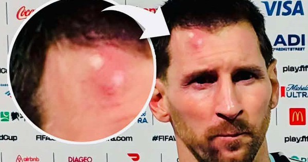 XX88 uy tín đồng hành cùng fan bóng đá: Cập nhật chấn thương Messi sau trận Cabo Verde - hình ảnh - appxx88.vip XX88 uy tín đồng hành cùng fan bóng đá: Cập nhật chấn thương Messi sau trận Cabo Verde - hình ảnh - appxx88.vip